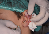 Otoplastica incisionless - Amerigo Giudice, medico chirurgo specialista in chirurgia maxillo-facciale